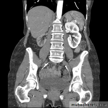 Renal artery stenosis