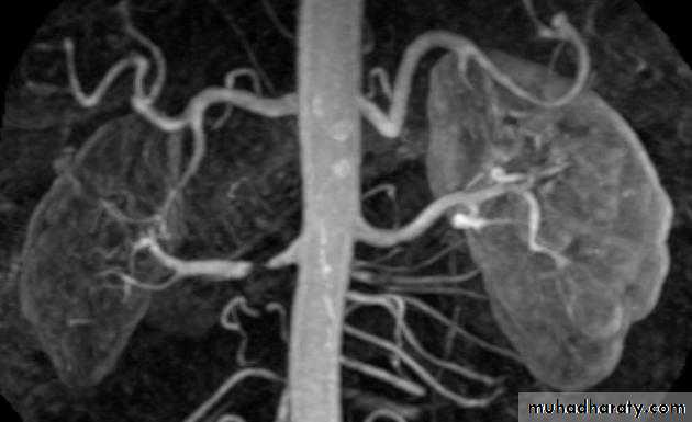 Renal artery stenosis