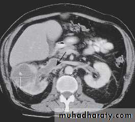 Tumors of the kidney and urinary tract