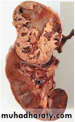 Tumors of the kidney and urinary tract