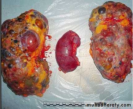 Adult polycystic kidney disease