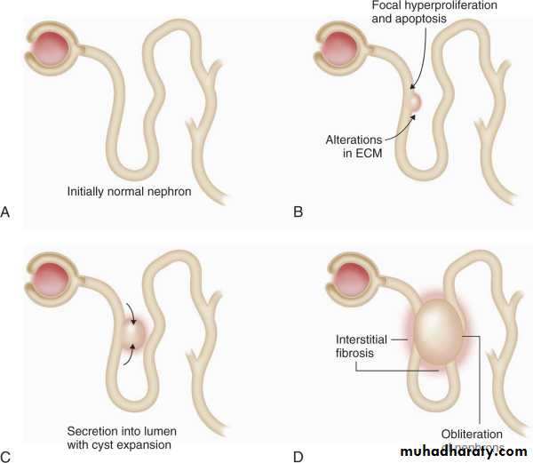 Adult polycystic kidney disease