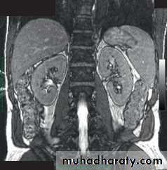 Adult polycystic kidney disease
