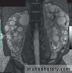 Adult polycystic kidney disease