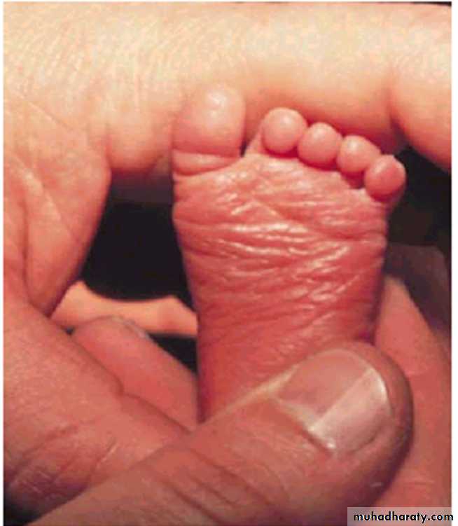 Prematurity