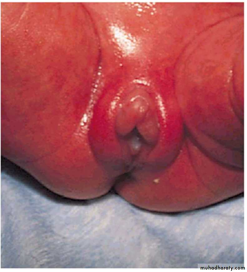 Prematurity