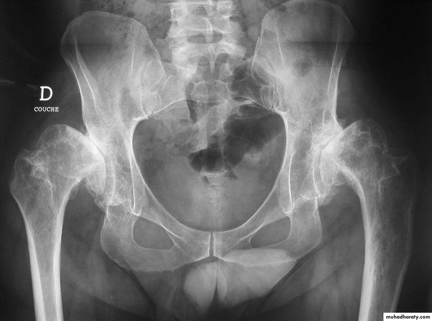 BONE
