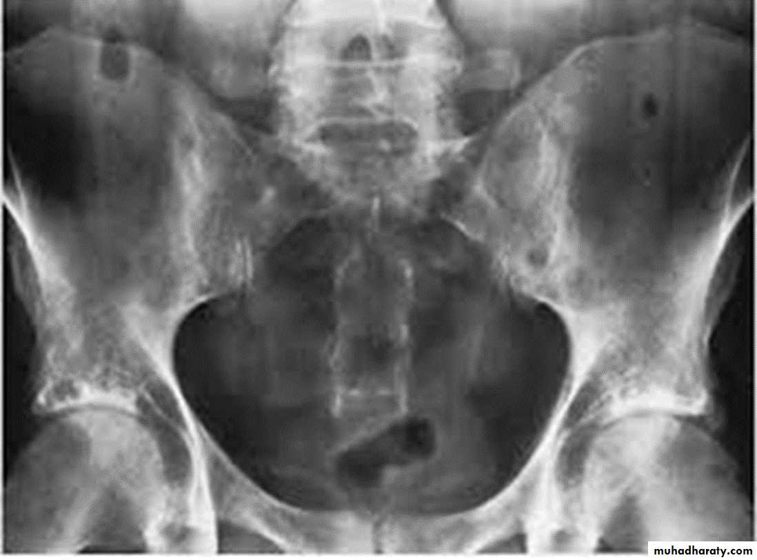 BONE