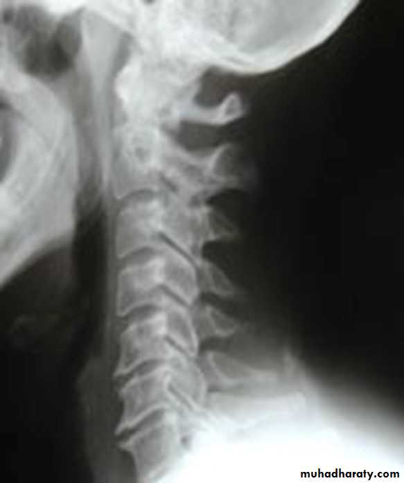 BONE