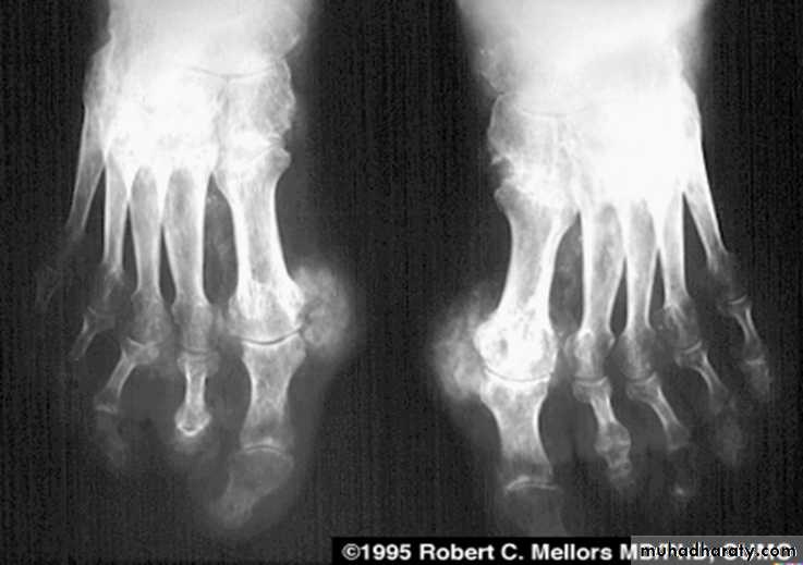 BONE
