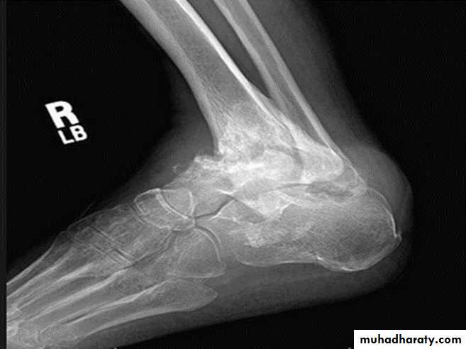 BONE