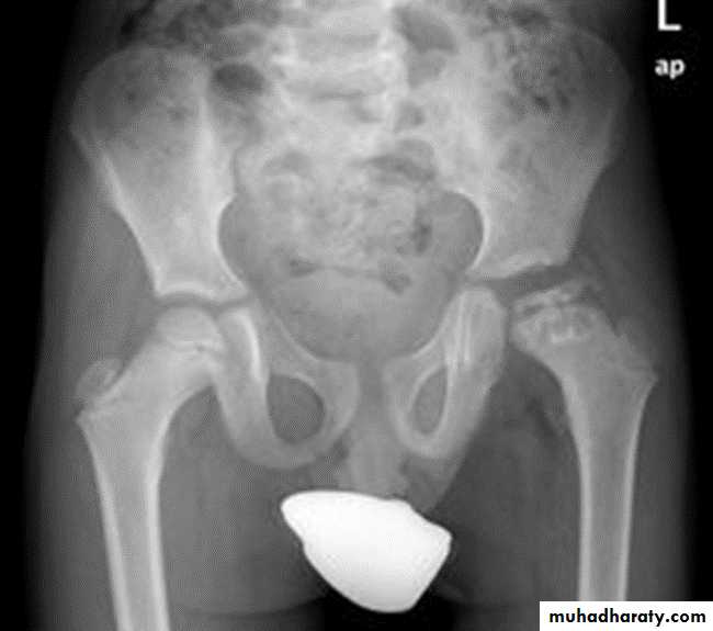 BONE