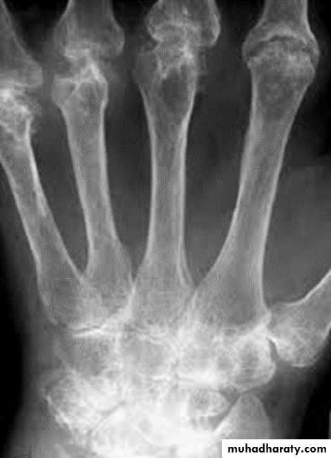 BONE