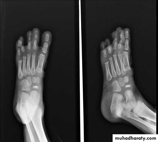 BONE