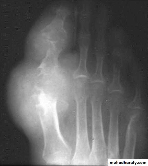 BONE