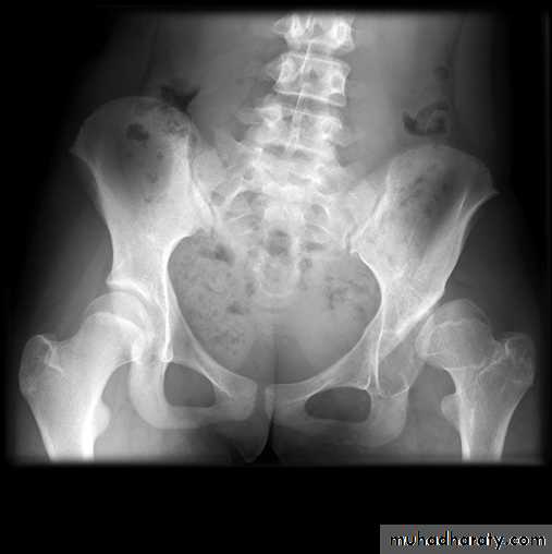 BONE