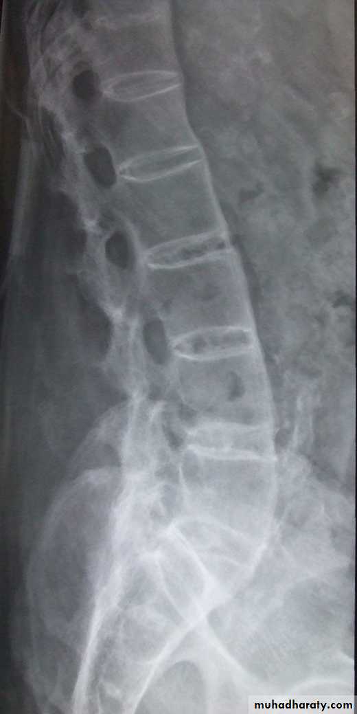 BONE