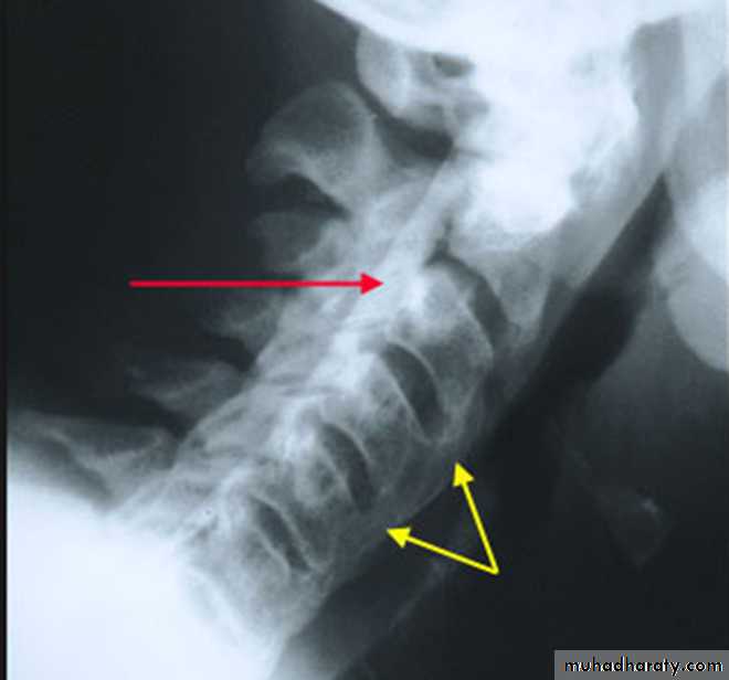 BONE