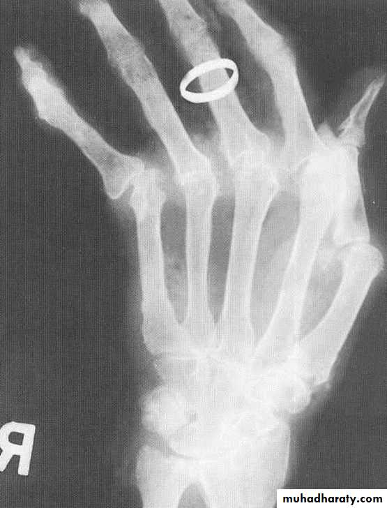 BONE