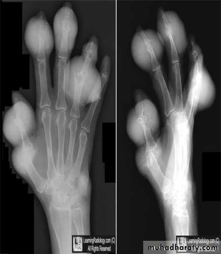 BONE