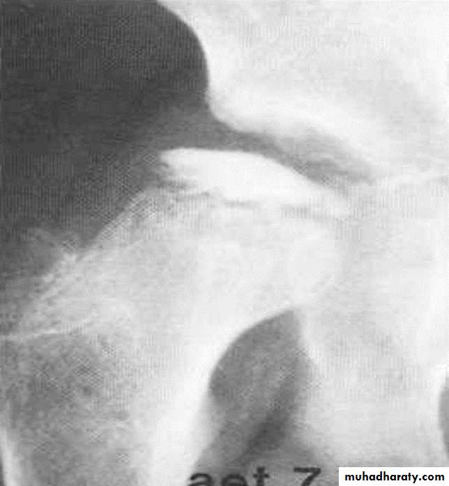 BONE
