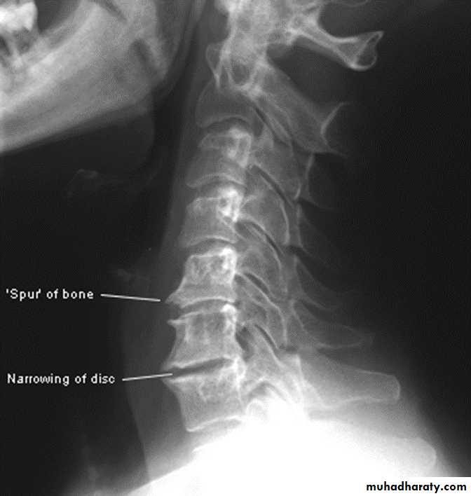 BONE