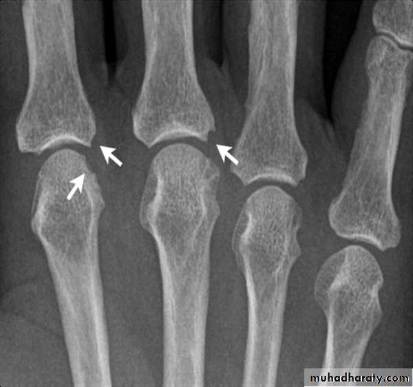 BONE