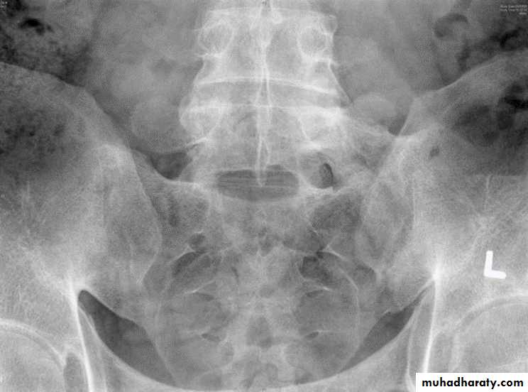 BONE