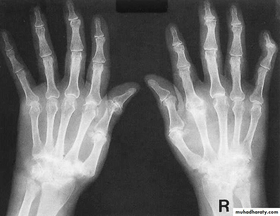 BONE