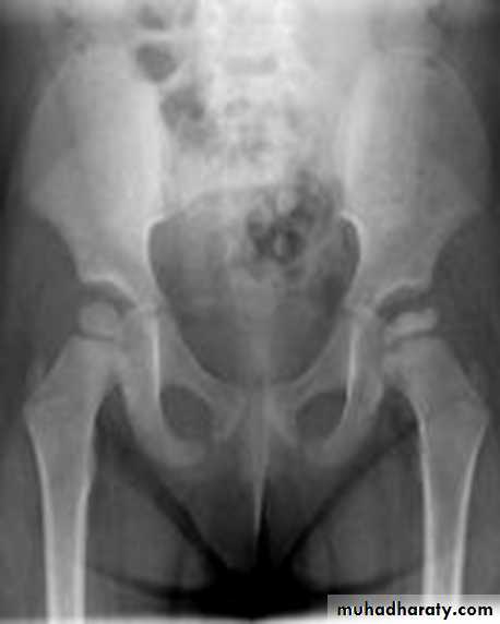 BONE