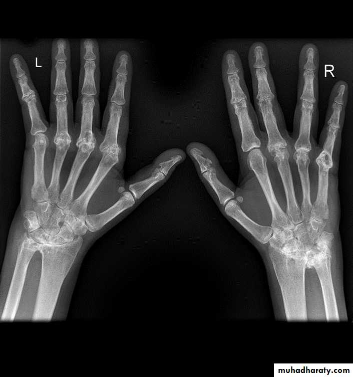 BONE