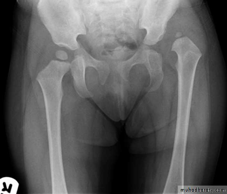 BONE