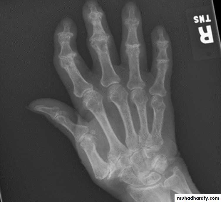 BONE
