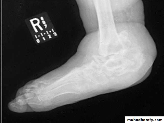 BONE