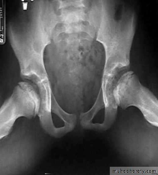 BONE