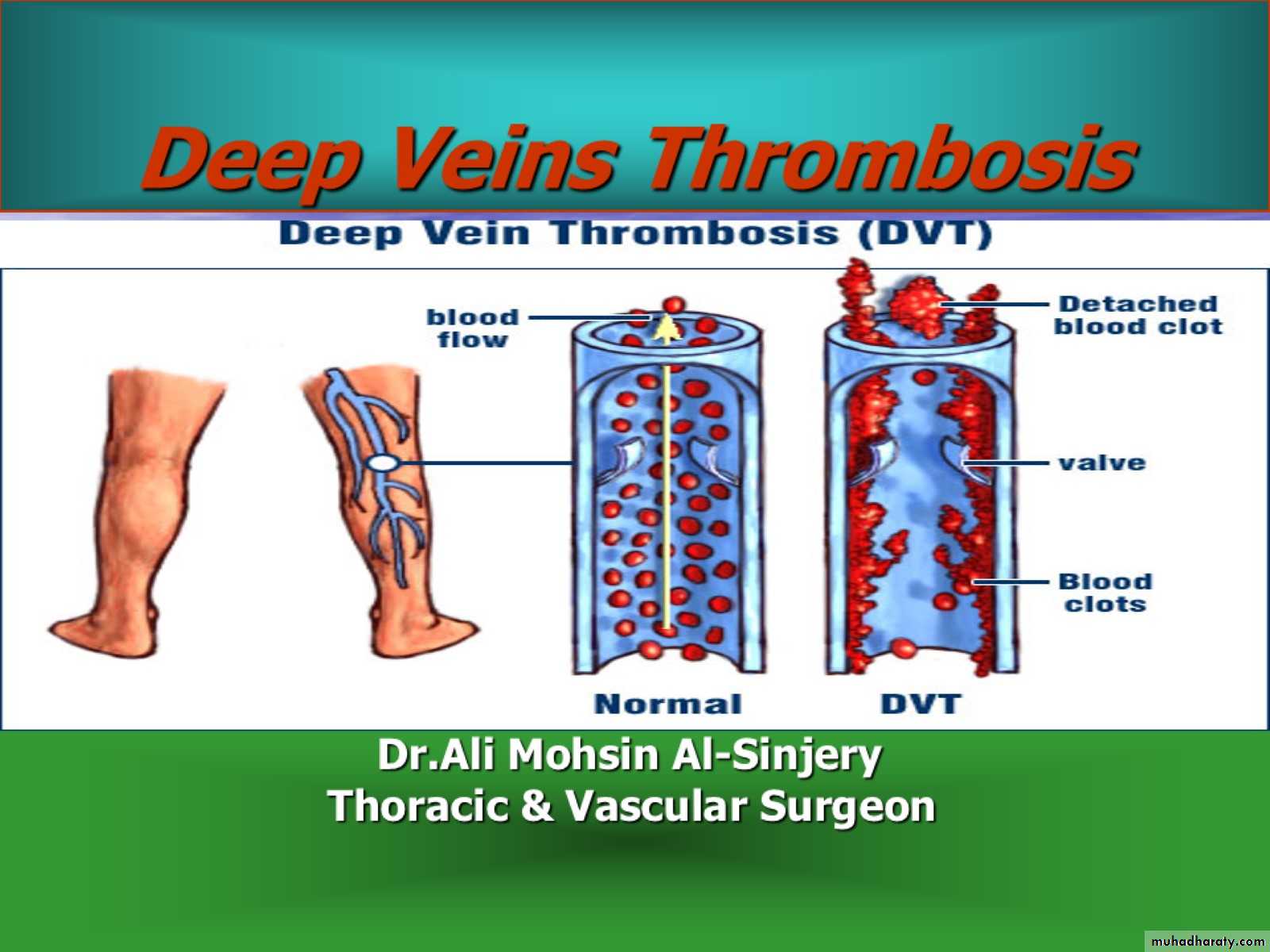 DVT