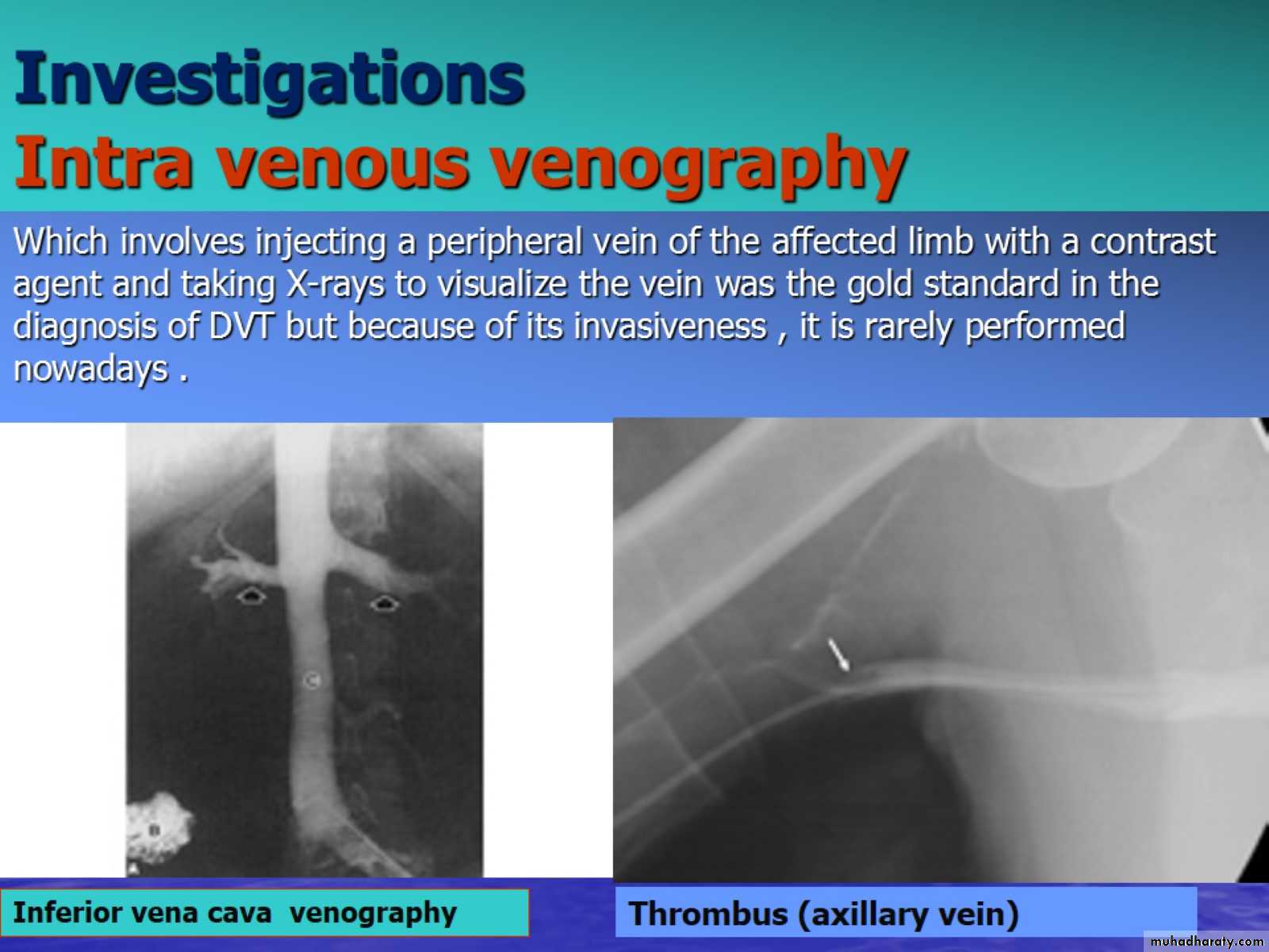 DVT