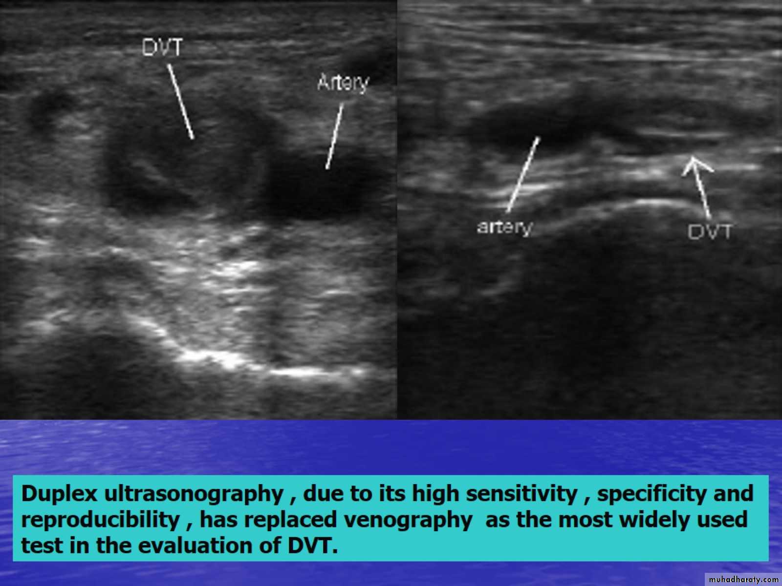 DVT