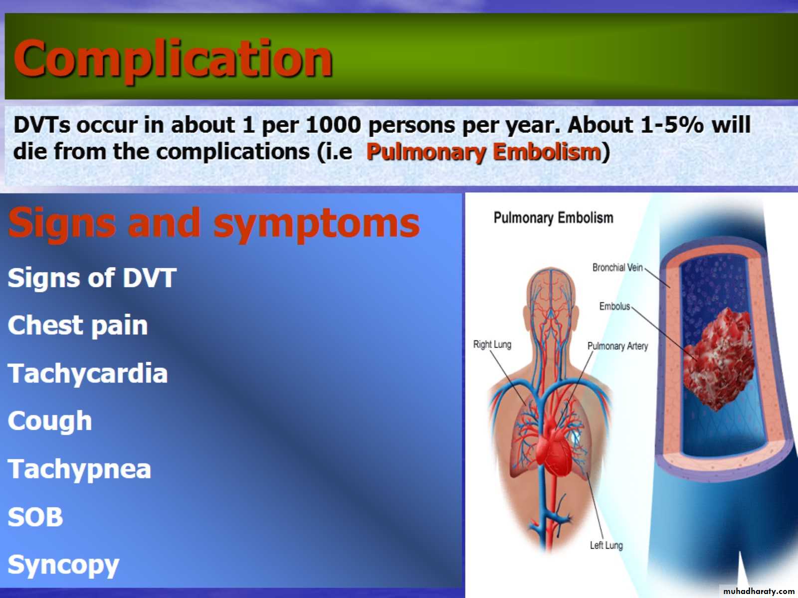 DVT
