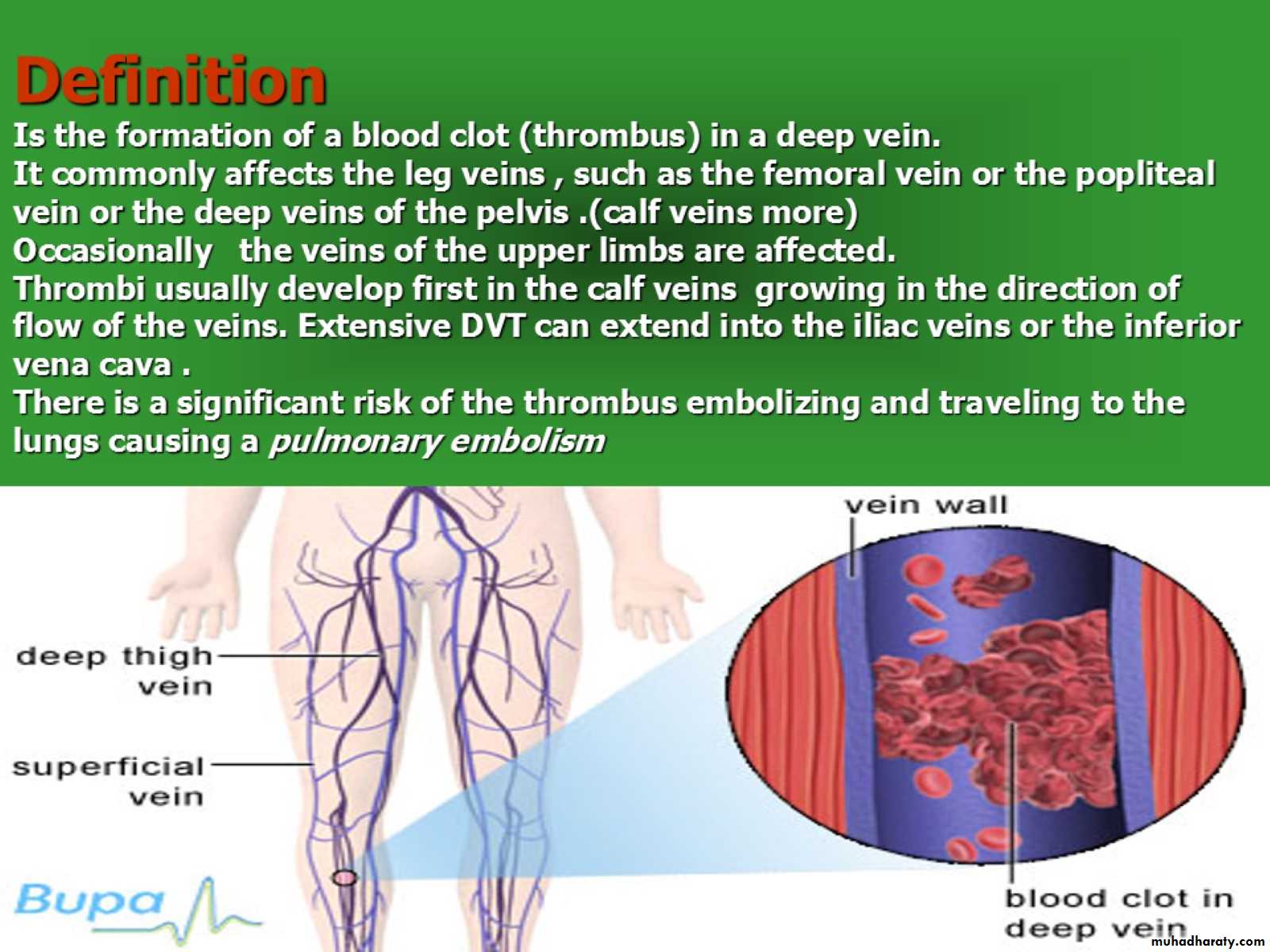 DVT