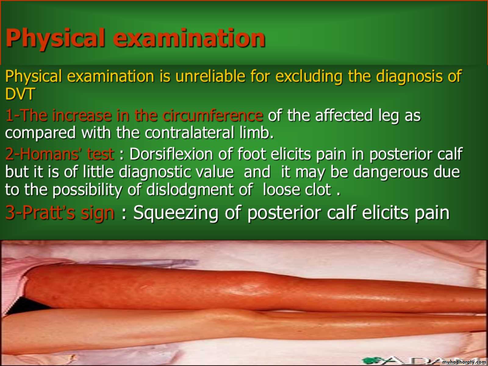 DVT
