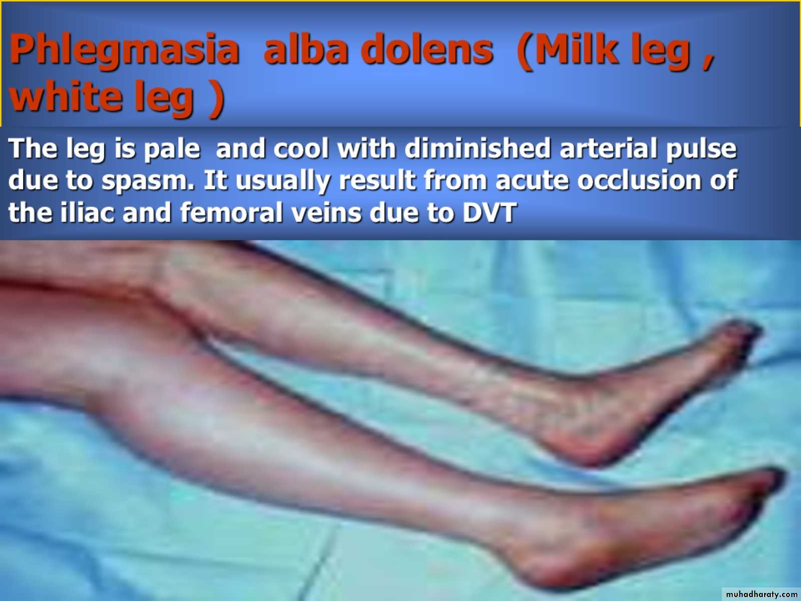 DVT