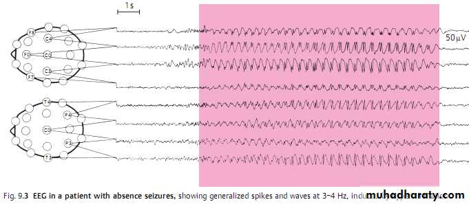 epilepsy