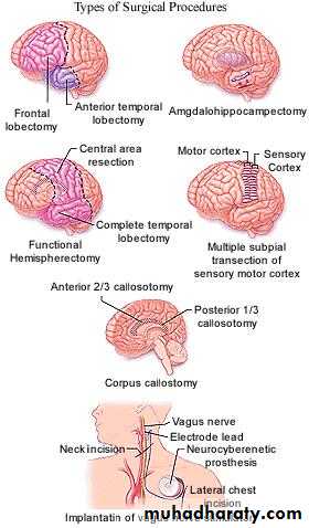epilepsy