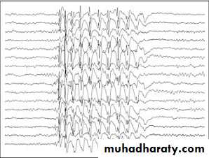 epilepsy