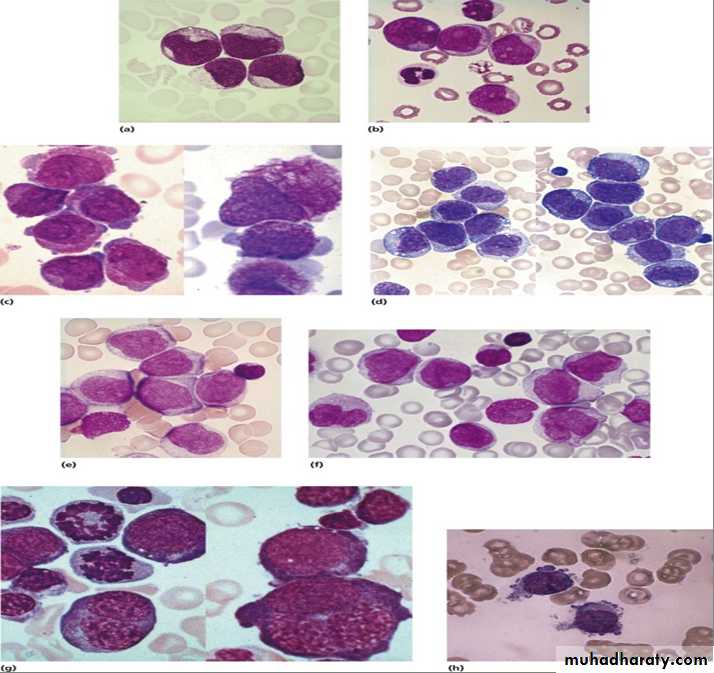 Acute myeloid leukaemia