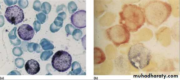 Acute myeloid leukaemia