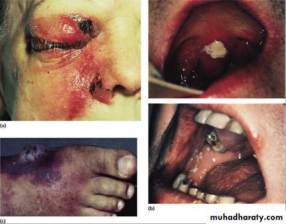 Acute myeloid leukaemia