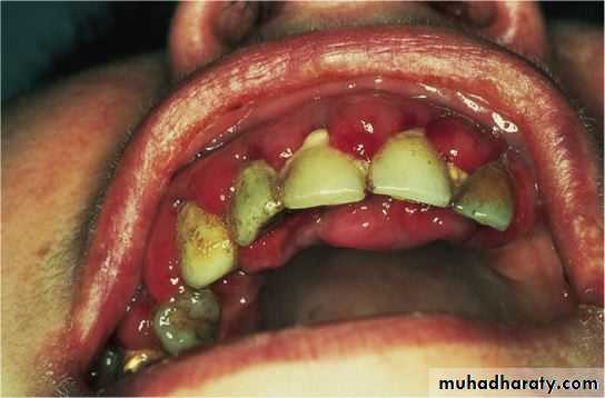 Acute myeloid leukaemia