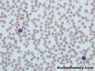 plasma cell tumors